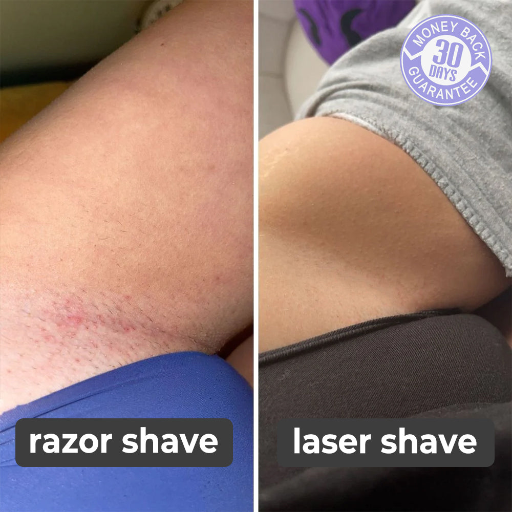 Laser | Ontharingsapparaat